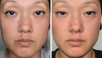 Before and after
